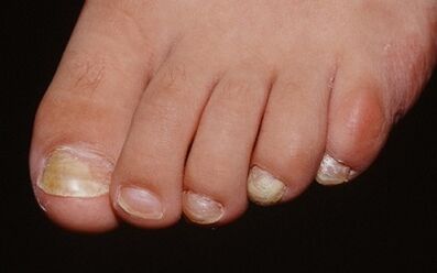 Reasons for the image of the mushroom on the thumb of the foot
