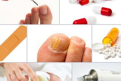 How to treat mushrooms on the nail