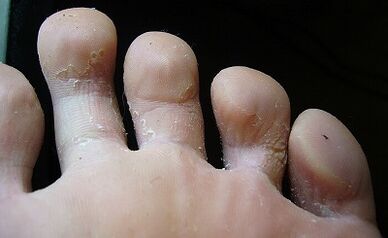 Mushrooms look like in the legs and how to treat