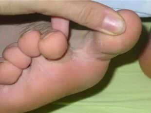 Itching of the toes