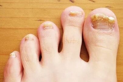 Nail trunk