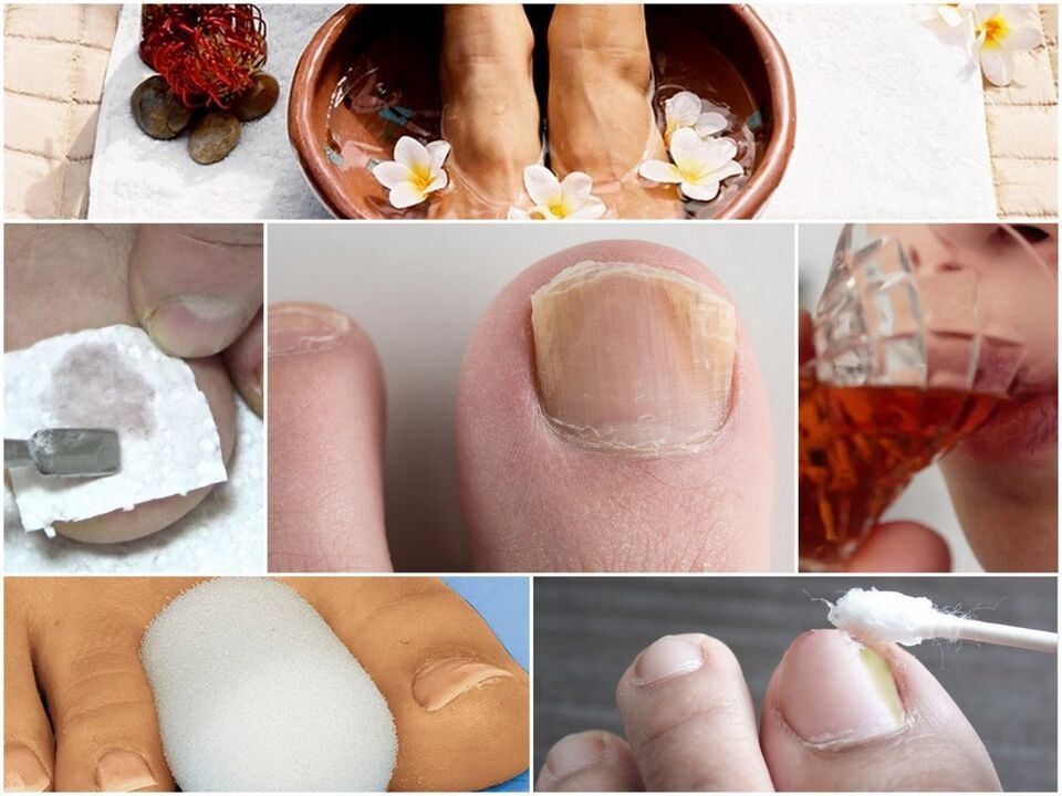Nail fungi