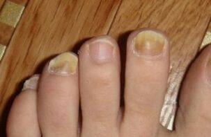Wrapping the nail due to fungi