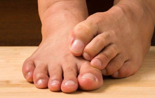 Toenail fungus and remedies for its treatment