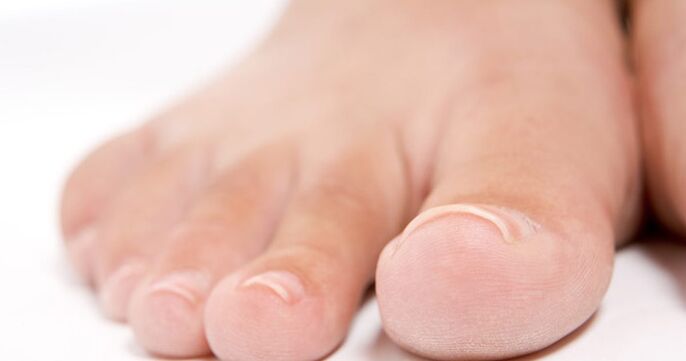 Toenails can be affected by fungal infection