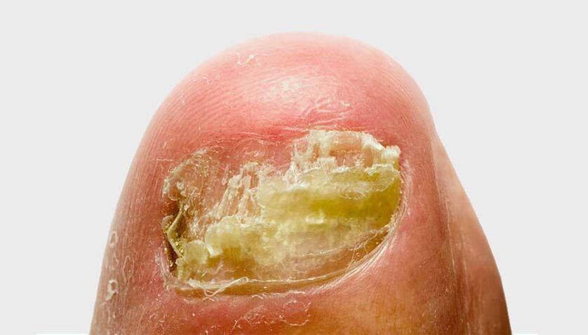 development stage of nail fungus